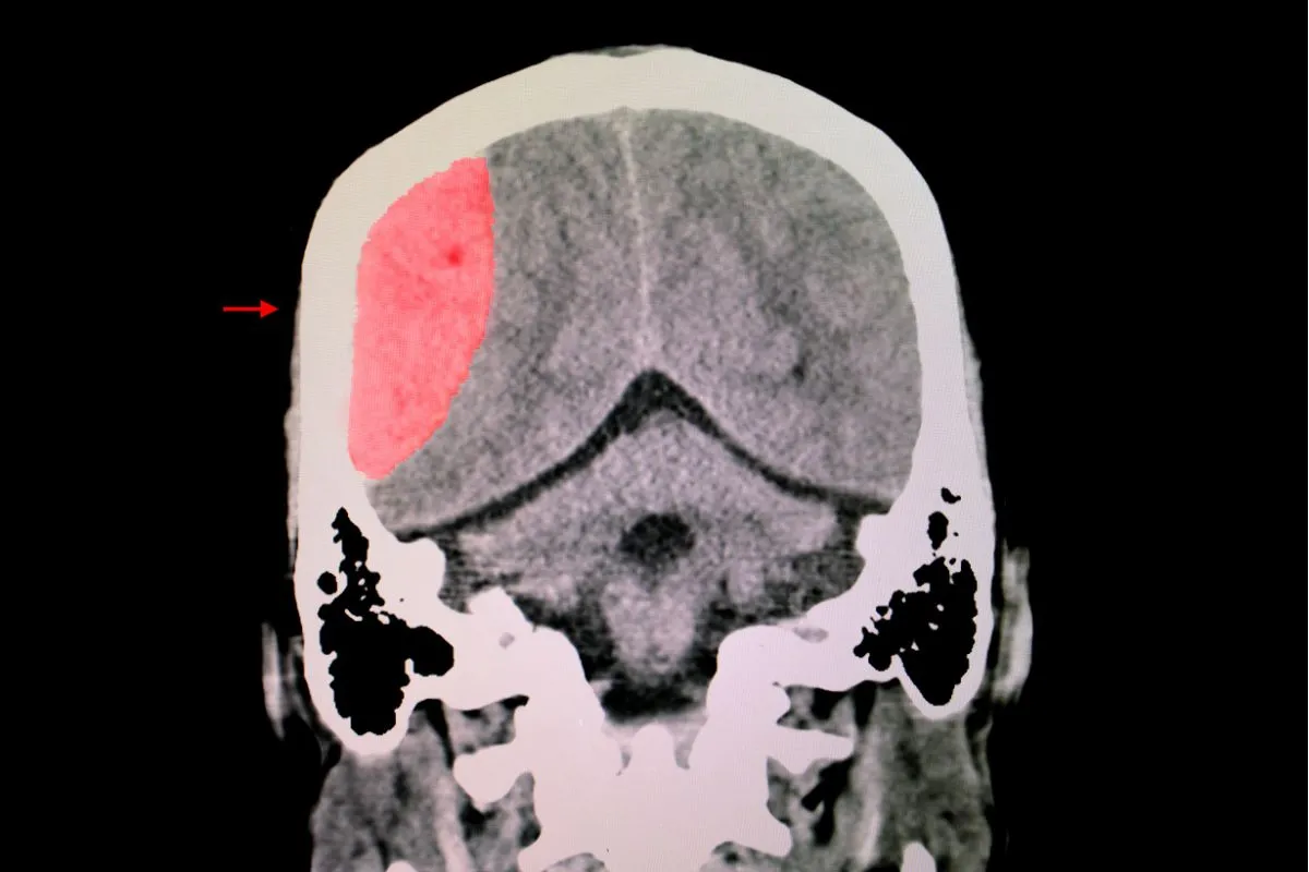 hyperbaric-oxygen-therapy-for-traumatic-brain-injury-and-ptsd