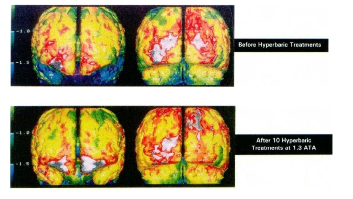 1.3 ata hyperbaric chamber study